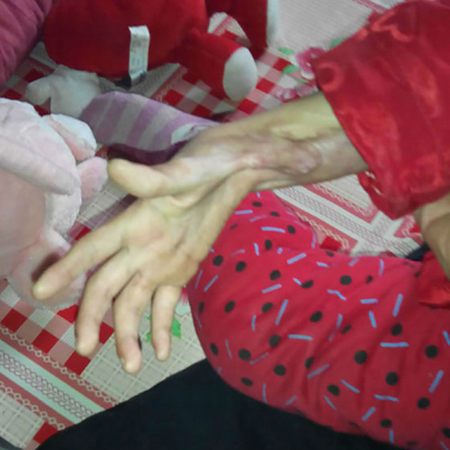 妤心植皮后，出現(xiàn)了非常嚴重的疤痕增生現(xiàn)象